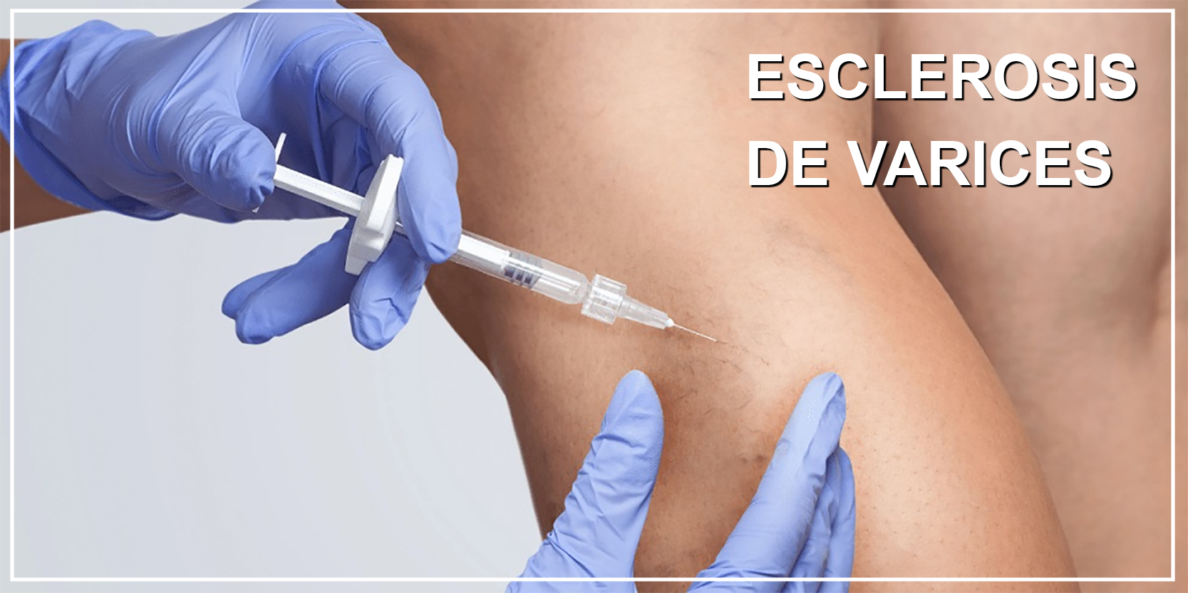 Esclerosis de Varices en Sevilla