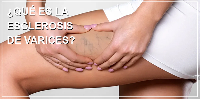 Esclerosis de Varices en Sevilla