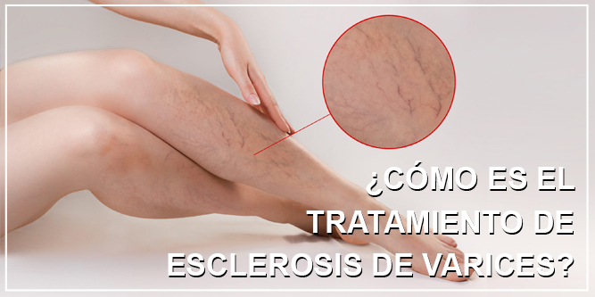 Esclerosis de Varices en Sevilla