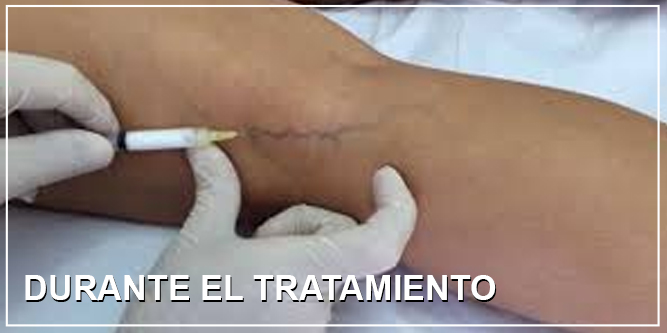 Esclerosis de Varices en Sevilla