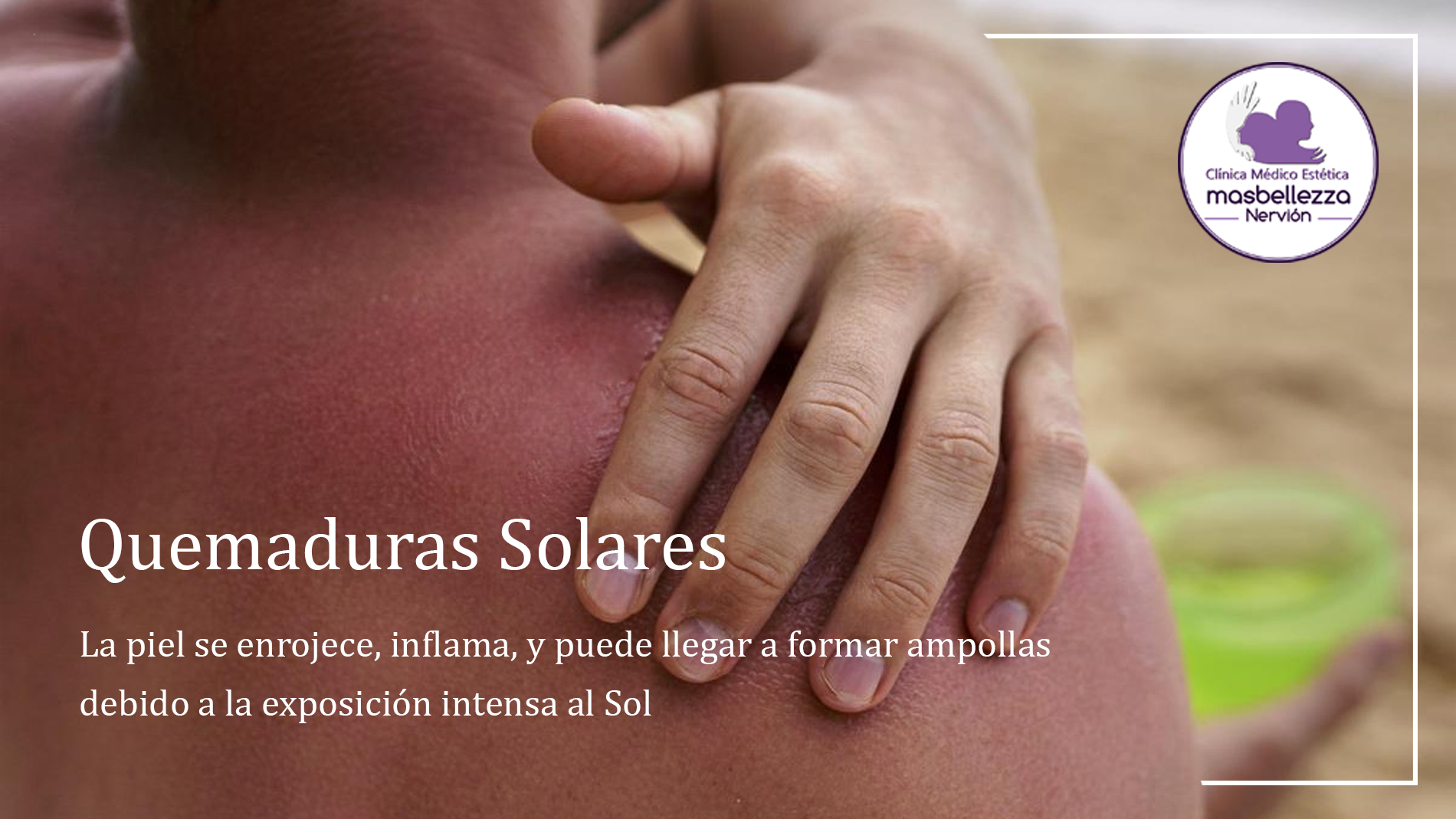 Quemaduras solares