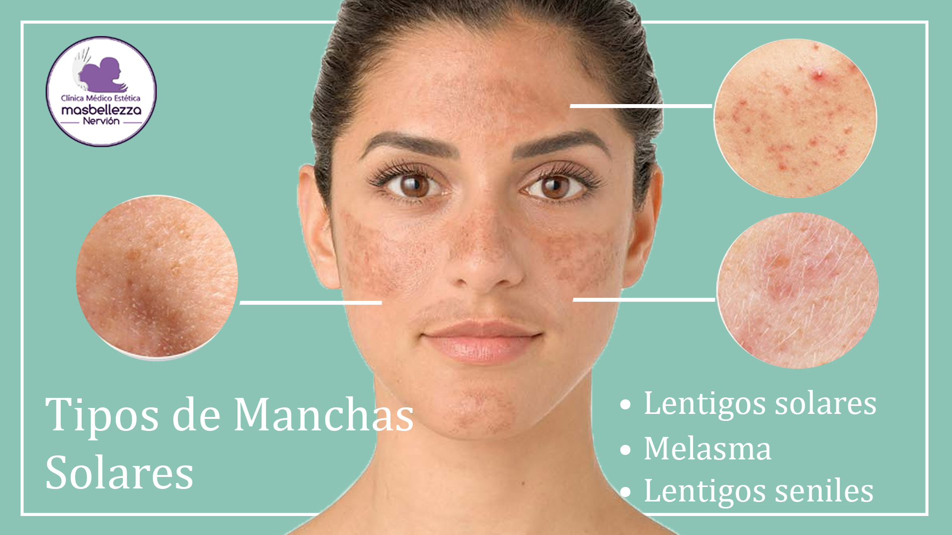 tipos de manchas solares