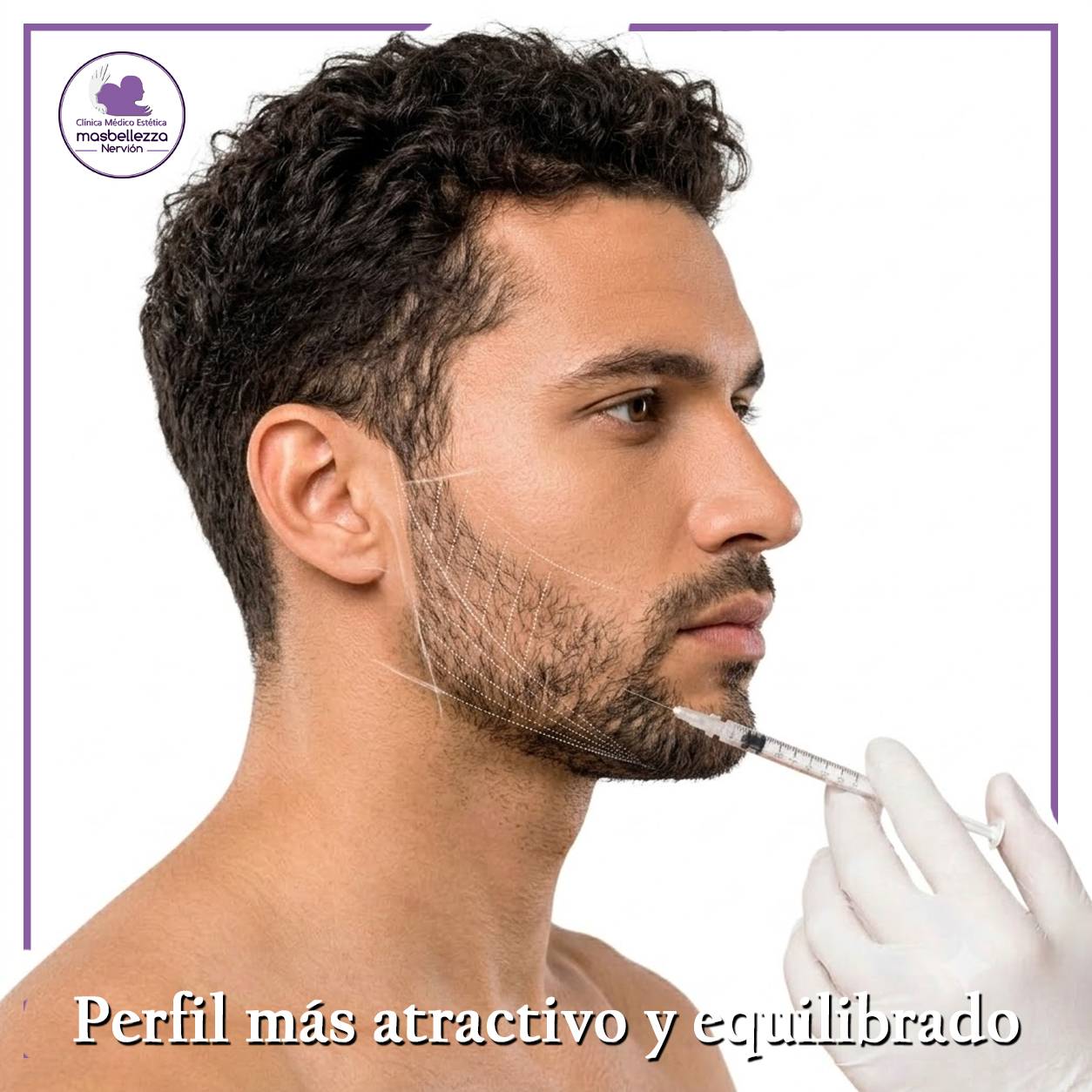 marcación mandibular con ácido hialurónico en Sevilla