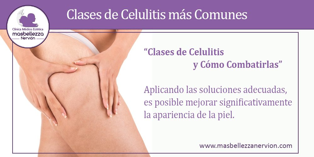 Clases de Celulitis más Comunes