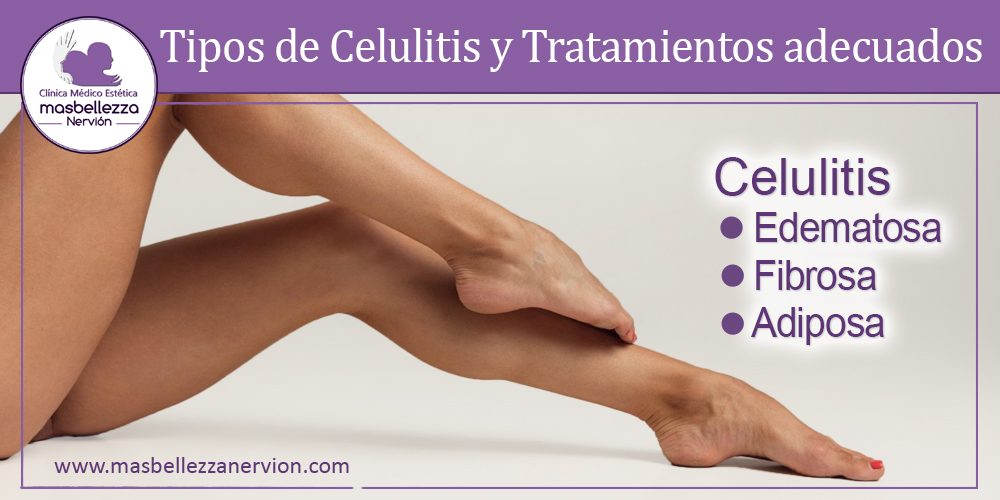 Tipos de celulitis y tratamientos para mejorarla