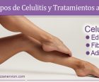 Tipos de celulitis y tratamientos para mejorarla