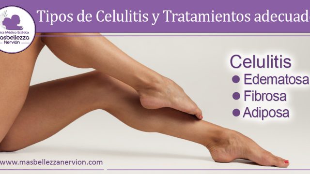 Tipos de celulitis y tratamientos para mejorarla
