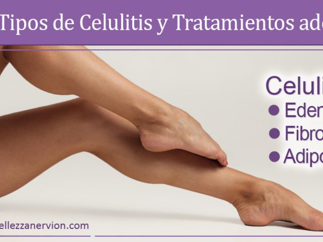 Tipos de celulitis y tratamientos para mejorarla